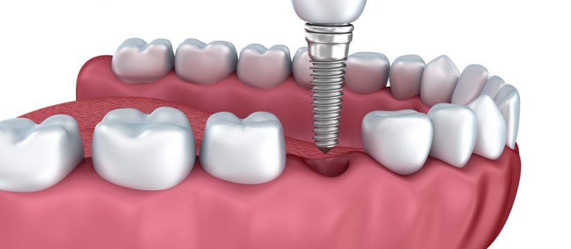 Where can I find the best dental implants in Kendall?