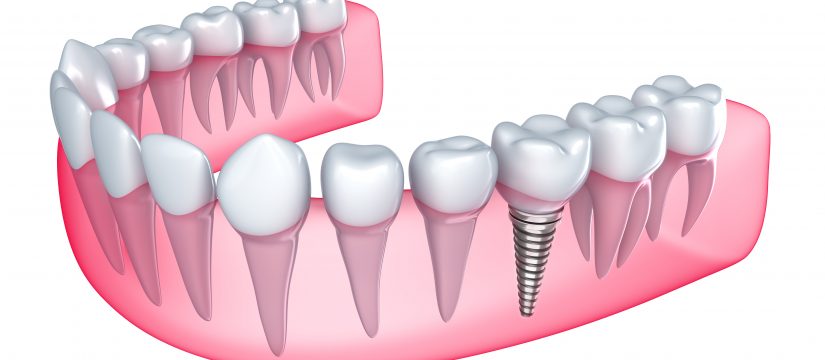 Where can I get Pembroke Pines Dental Implants ?