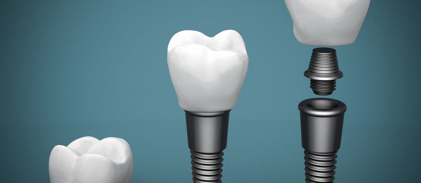 Who is the best dentist for Dental Implants in Kendall ?